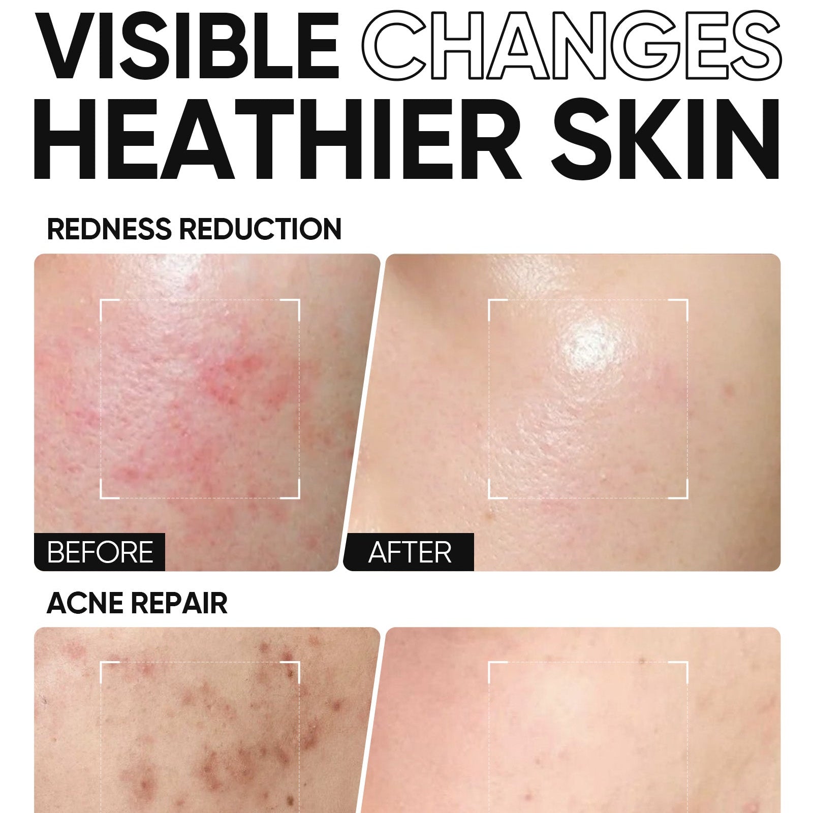 5X Ceramid Barriere Feuchtigkeits-Gel