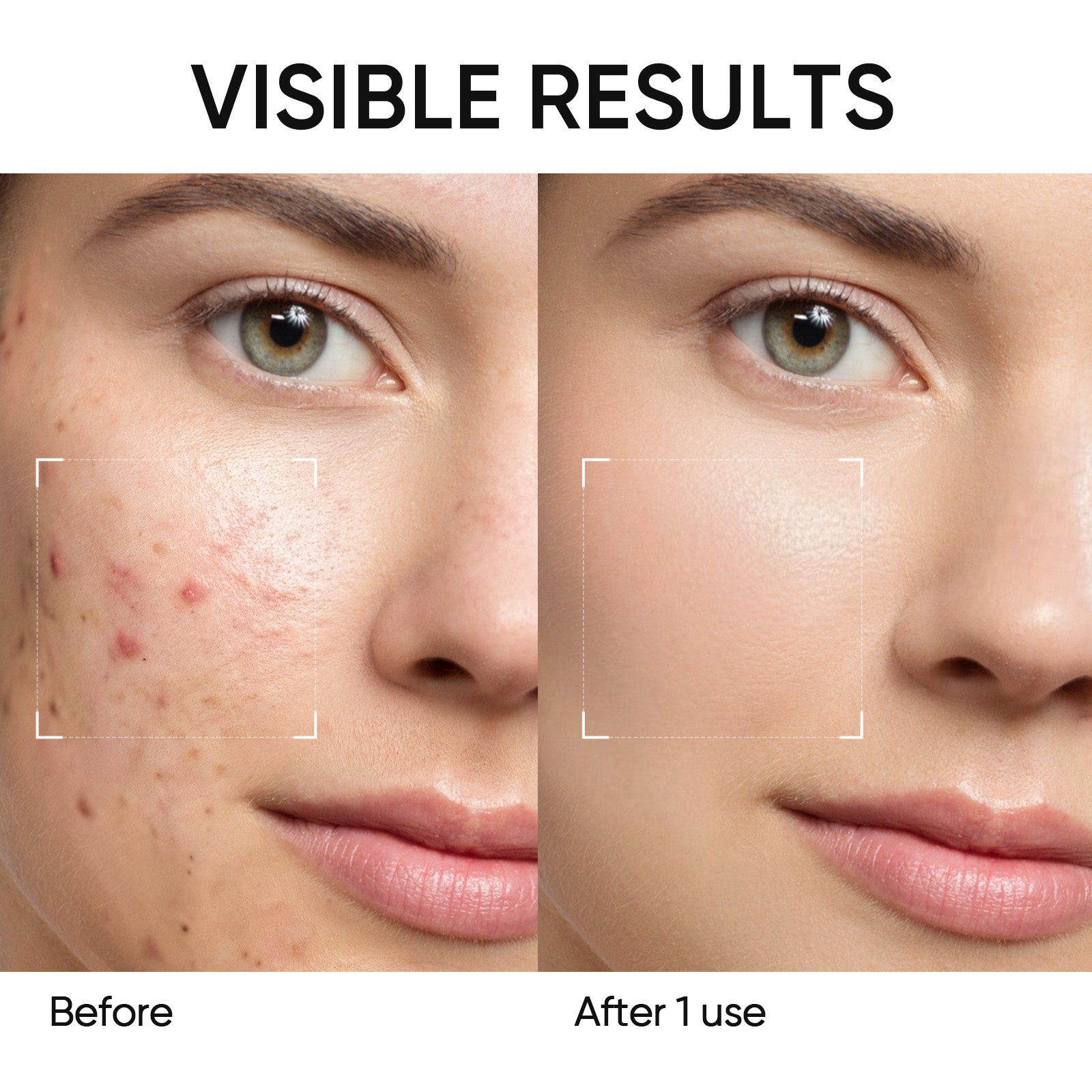 Beifuß Akne Tonerde-Stick