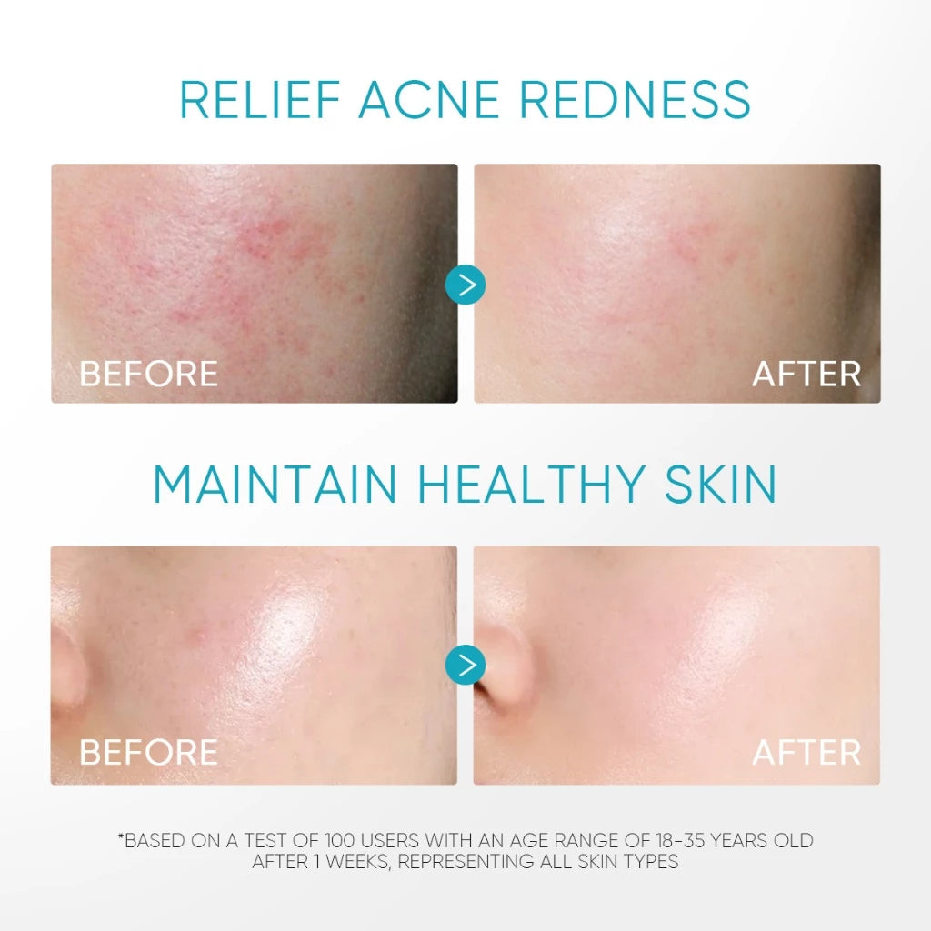 5% Panthenol Akne-Beruhigendes Wasser-Gel