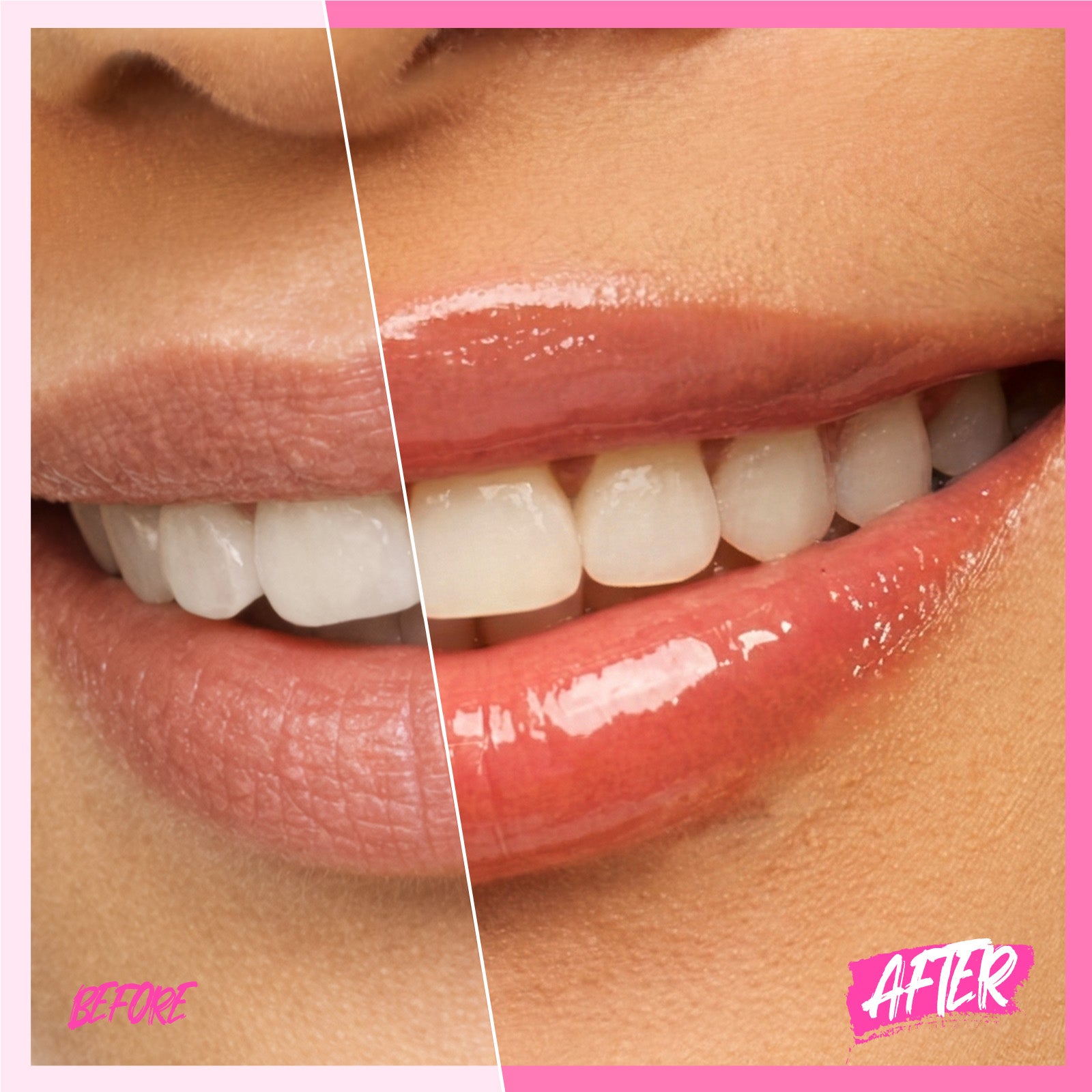 Peptid Aufhellendes Lippen-Serum