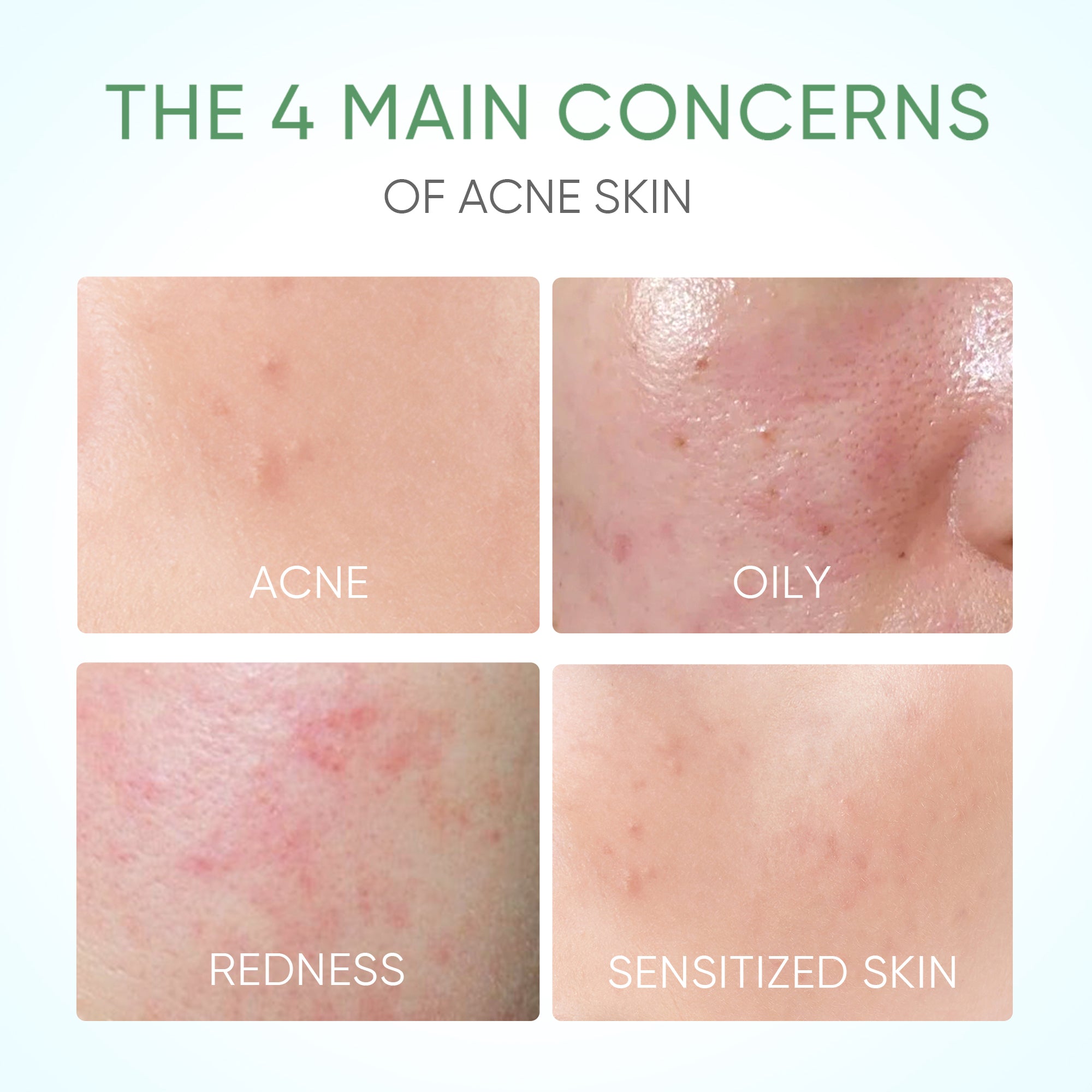 Pure Centella Akne Beruhigender Toner 80ml für sensible & zu Akne neigende Haut